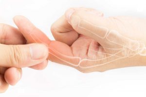 Bệnh Viêm khớp tay: Triệu chứng, Điều trị
