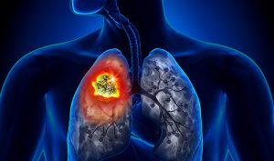 Bạn có thể thực hiện những bước nào để giảm nguy cơ mắc bệnh ung thư phổi?